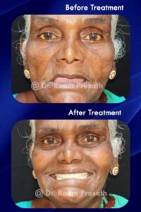 dr raam prasath dental implants