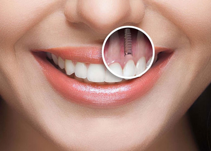 Long-Term Benefits of Dental Implants