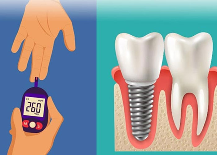 Dental implants and Diabetes
