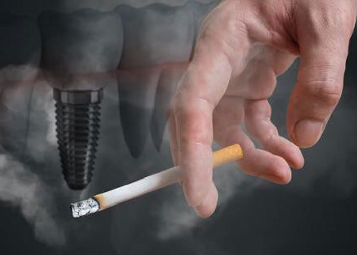 How Smoking Affects Dental Implants: Facts You Shouldn’t Ignore